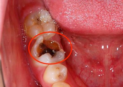 あなたの虫歯の症状をチェック 最適な治療法 費用 歯医者の選び方