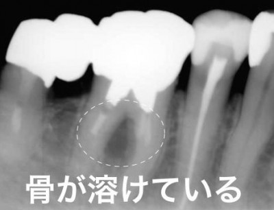 歯 の 骨 が 溶ける 治療