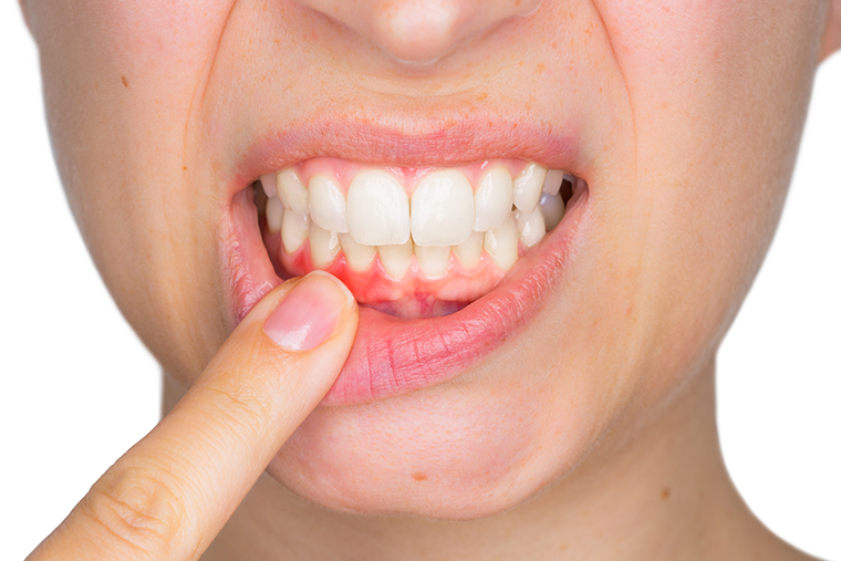 歯茎 の 腫れ に 効く 薬