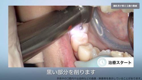 前歯も奥歯も健康保険で白い歯が入れられる 銀歯を使わない治療法