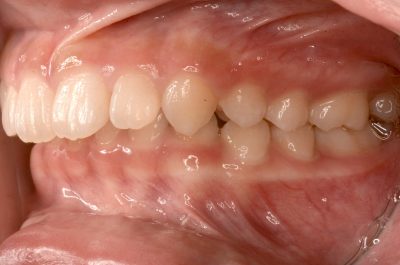 出っ歯の３つの治し方 セラミック 部分矯正 歯列矯正の費用と期間を徹底比較