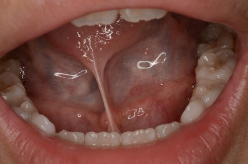 短時間で終わる舌小帯 上唇小帯の切除法と腫れや痛みの費用について