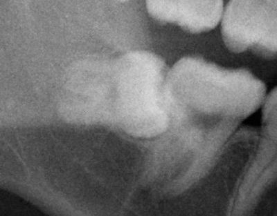 すべての生え方で解説 親知らず抜歯法と期間 費用 抜歯後の対処法