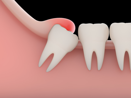 親知らずの腫れ 痛みはいつまで 抜歯前の注意点と抜歯後の対処法