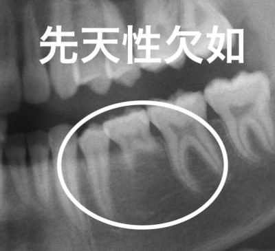 レントゲン 乳歯 年齢別のパノラマX線写真