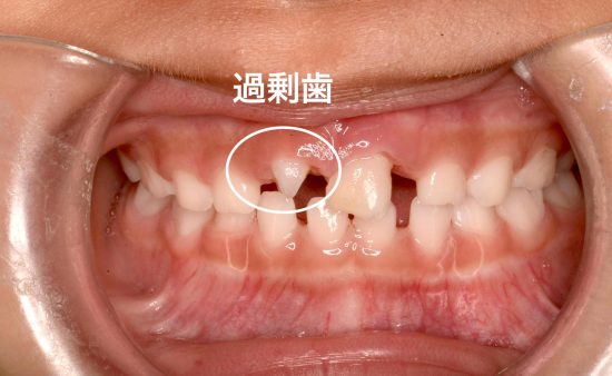過剰歯とは 子供の過剰歯の抜歯をすすめる６つの理由と費用 流れ