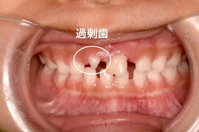 過剰歯とは？子供の過剰歯の抜歯をすすめる６つの理由と費用・流れ